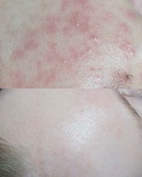 Huidindactie Acne Beautique Salon - huidverbetering - huidverbeterende behandelingen