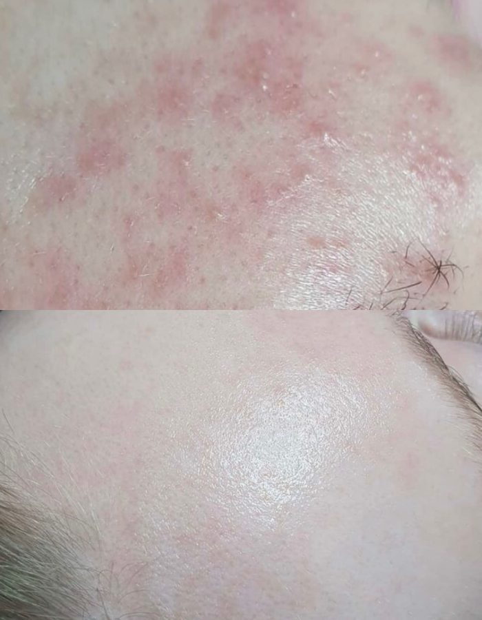 Huidindactie Acne Beautique Salon - huidverbetering - huidverbeterende behandelingen